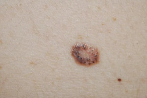 Cancers de la peau : l’IA aide au dépistage, sans remplacer  ... Image 1